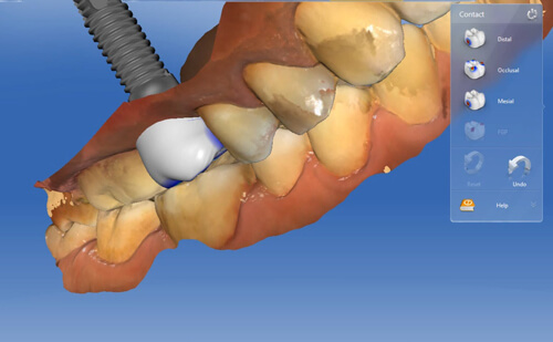 cerec crown