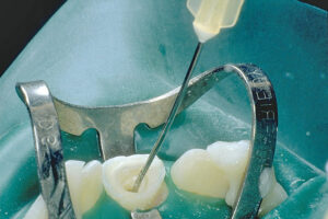 root canal treatment