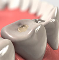 Warranty dental fillings