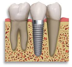 benifits-and-risk-dental-implant