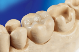 ceramic-inlay