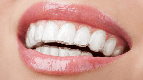 clear aligners