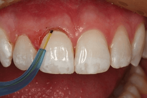 dental laser surgery