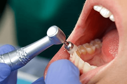 oral prophylaxis