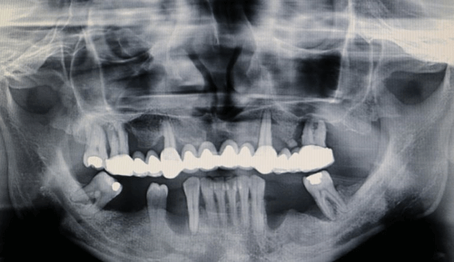 panoramic x-ray