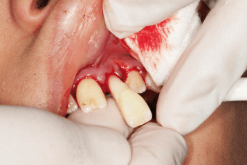 replantation of tooth