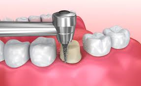 tooth preparation
