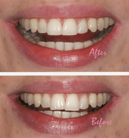 tooth recontouring