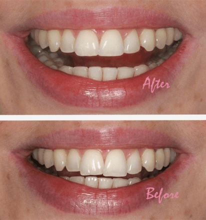 Cosmetic dentistry