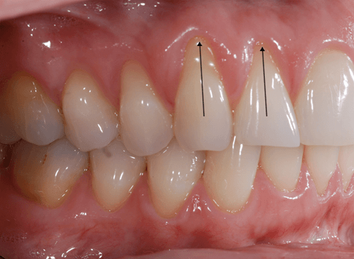 Gingival recession