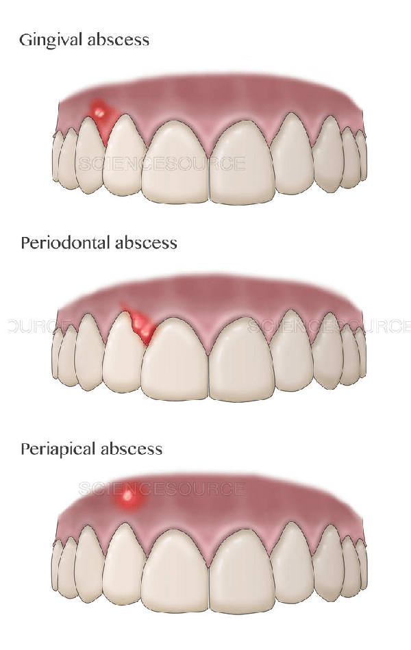 Dental Abscess