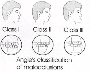 angle classification