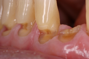 dental abrasion