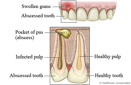 how to drain a periodontal abscess at home