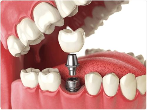 dental implant abutment crown