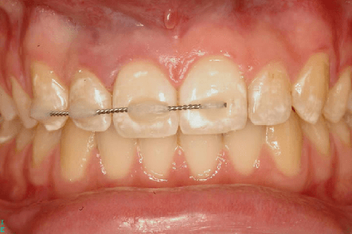 dental splinting
