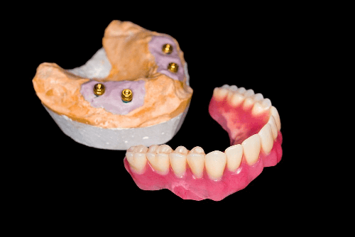 locator attachment denture