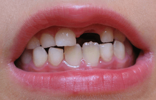 missing tooth