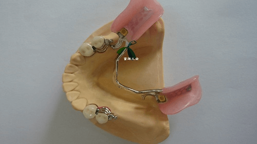 precision denture