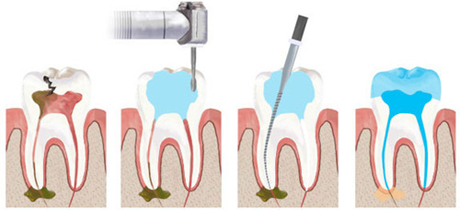 pulpectomy