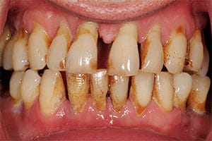 periodontal-disease