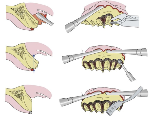 alveoplasty