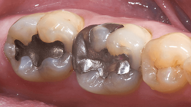 amalgam filling