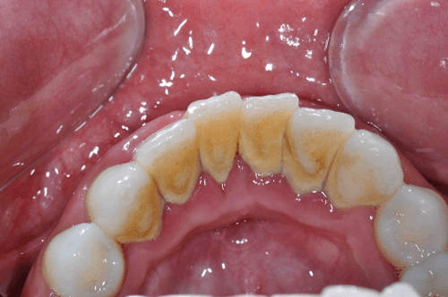 calcular deposit