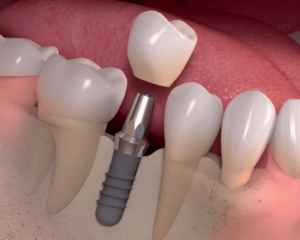 dental-implant