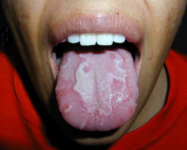 fungal infection burning mouth