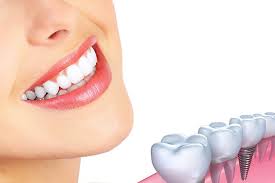 dental implant philippines