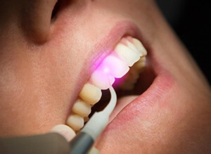 dental laser treatment