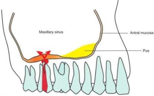 odontogenic sinusitis