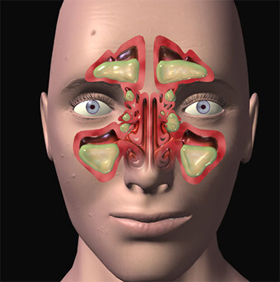 sinusitis