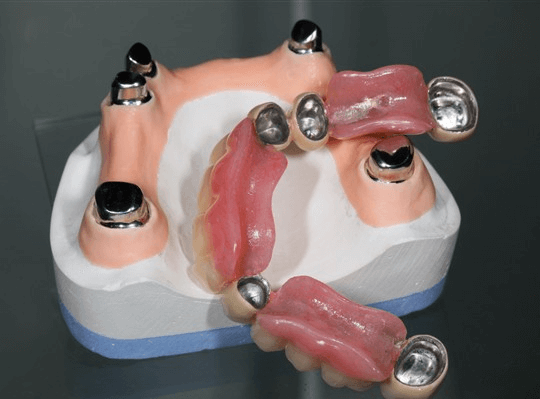 Telescopic-denture
