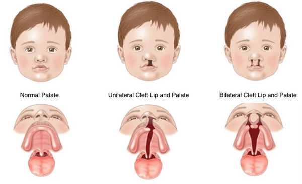 bilateral-cleft-palate