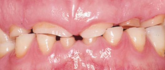 bruxism