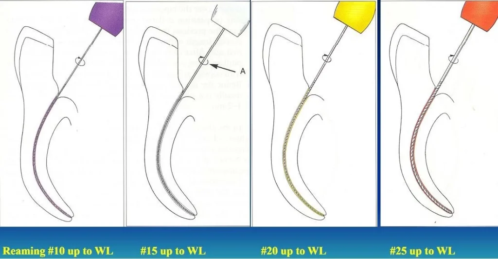 canal-preparation-endodontics