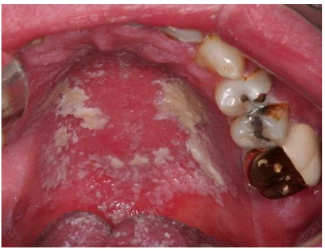 candida-albicans