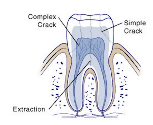 cracked-teeth-stages