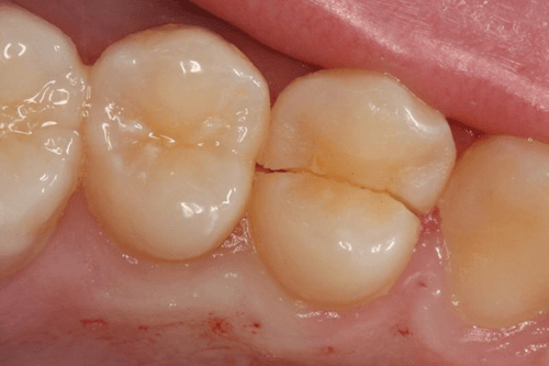 cracked-tooth