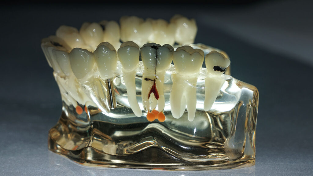 dental-implants