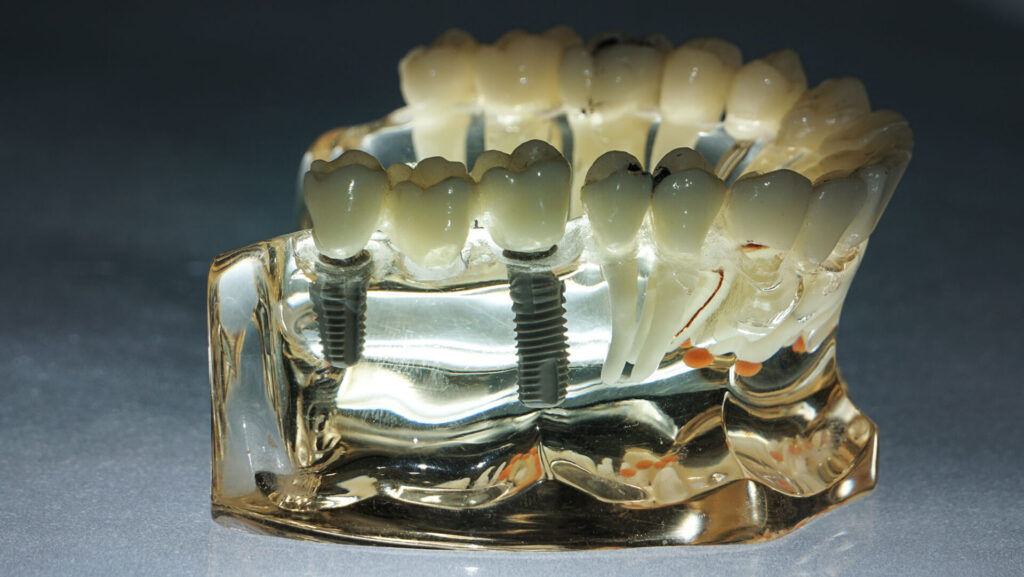 dental-implants1