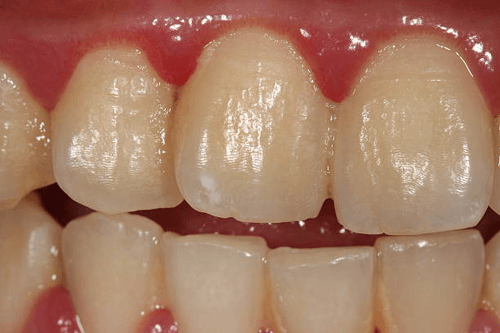 dental-plaque