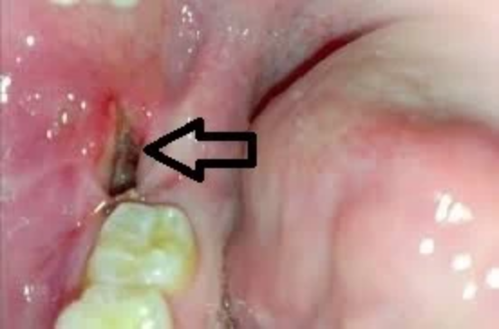 dry-socket