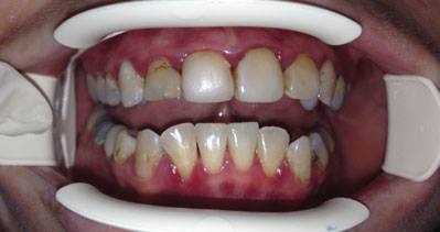 full mouth reconstruction manila philippines