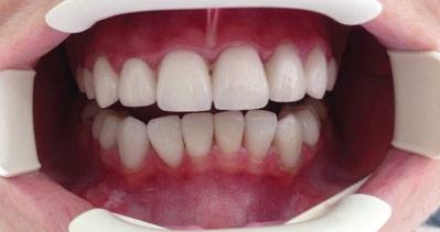 Full Mouth Reconstruction | Tooth & Go Dental Clinic