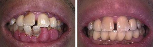 hyperplasie gingivale