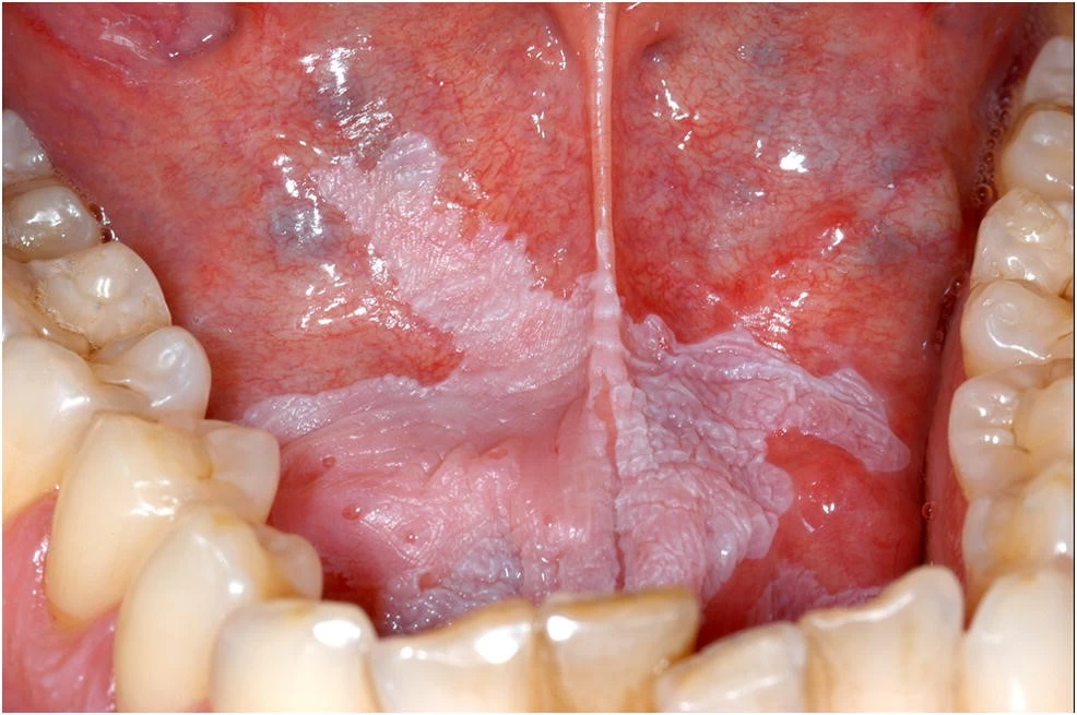 leukoplakia