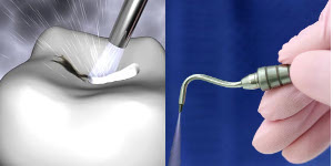 micro-air-abrasion